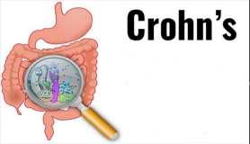 Crohn: Σοβαρές και οι ψυχολογικές επιπτώσεις της νόσου