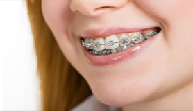 Σιδεράκια στα δόντια: Πρώτες βοήθειες για τα πιο συνηθισμένα απρόοπτα